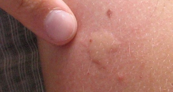 U Evropi sve više opasnih vrsta komaraca koji prenose bolesti